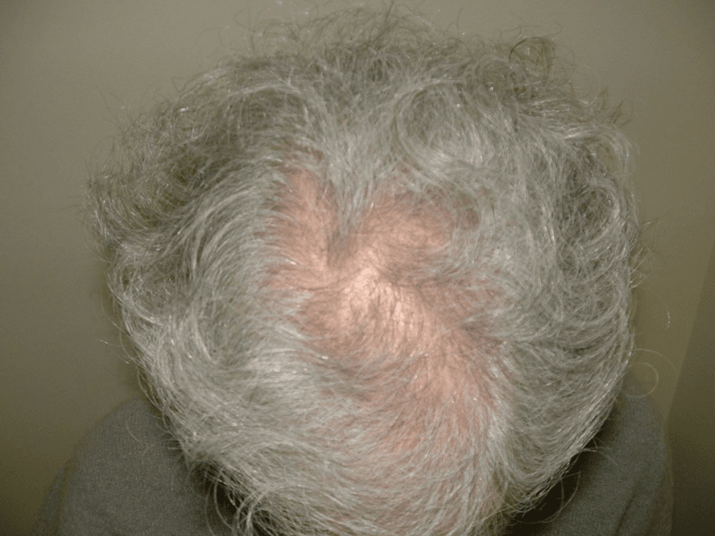 Thinning Hair