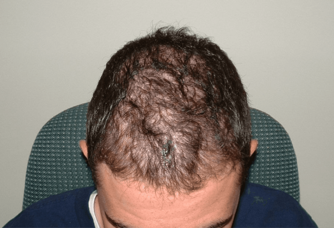 Hairline Recession